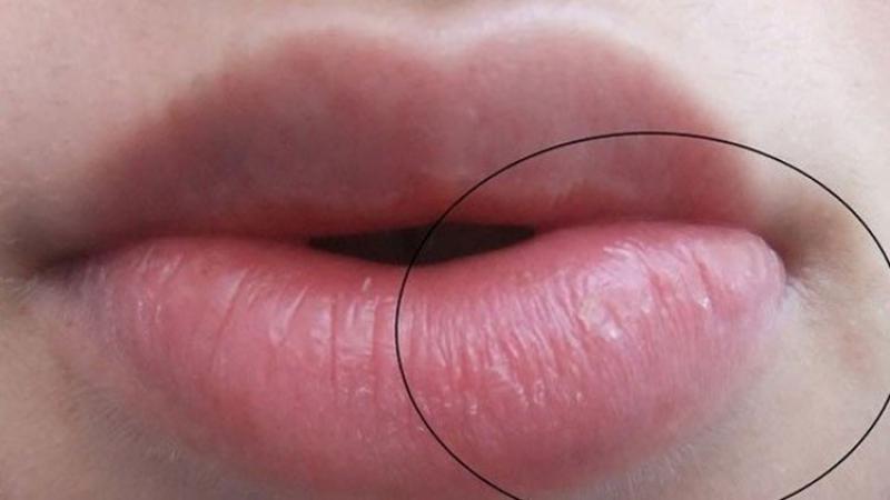 Формы половых губ у девушек персик щавель. Хейлит Манганотти эрозия. Гиповитаминозный хейлит.